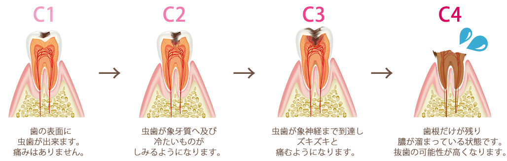 むし歯の進行について