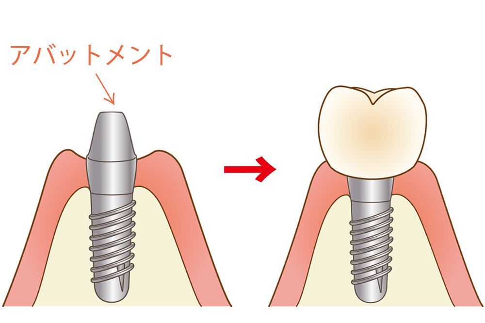 人工の歯を取り付ける