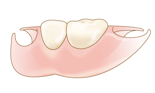 キレイデス（目立たない部分入れ歯）