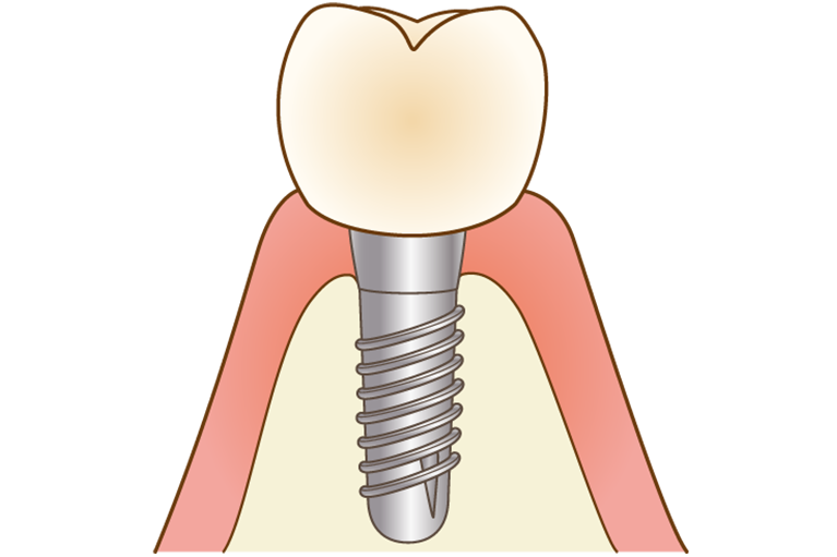 インプラント周囲炎