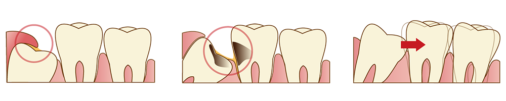 親知らずの症状